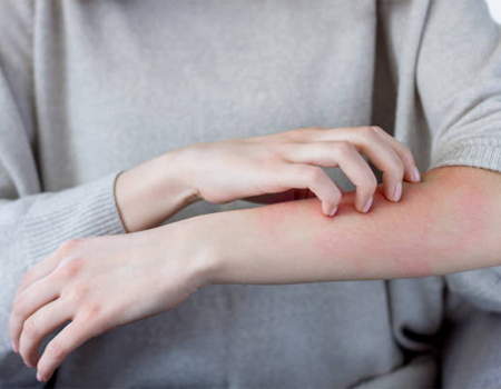 Allergy