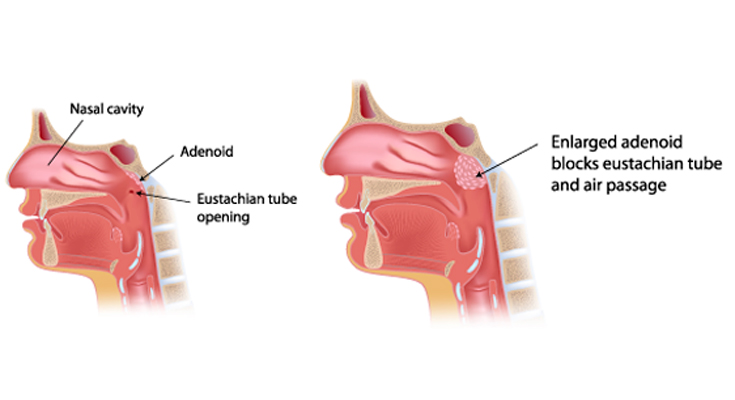 Adenoidectomy Doctor in Ahmedabad Adenoidectomy Doctor in Ahmedabad