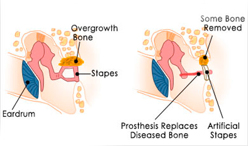 Otosclerosis and stapes surgery — Hearing Institute