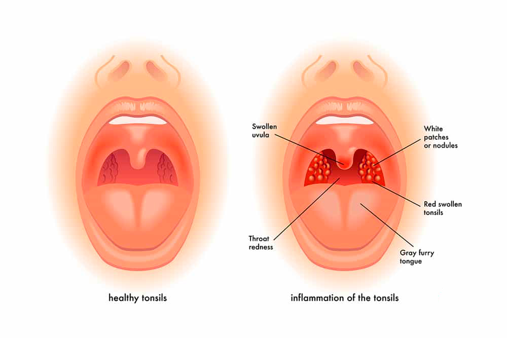 Throat Surgeon in Palanpur Throat Surgeon in Palanpur