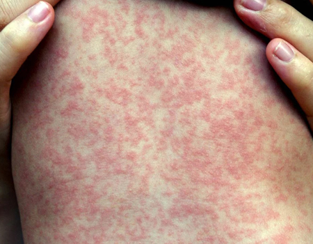 Skin-Allergy